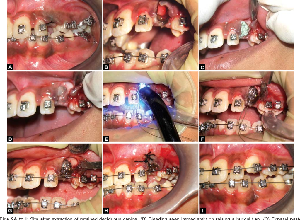🇫🇷 collage bracket per-opératoire chirurgie buccale