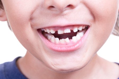 enfant souriant montrant ses dents de lait