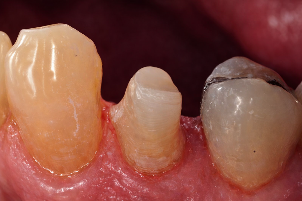 Reconstitution complexe des dents