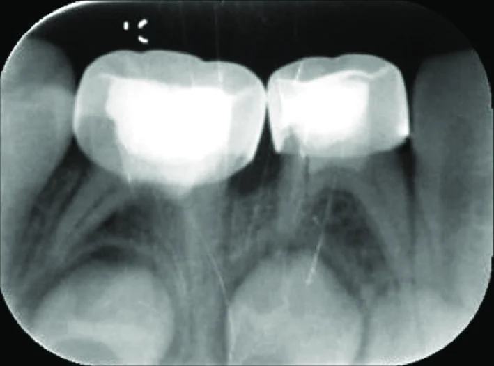 Radiographie rétroalvéolaire — épaississement ligamentaire sur molaire temporaire