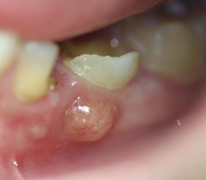 Photo clinique d'une parulie (abcès gingival) sur dent temporaire nécrosée