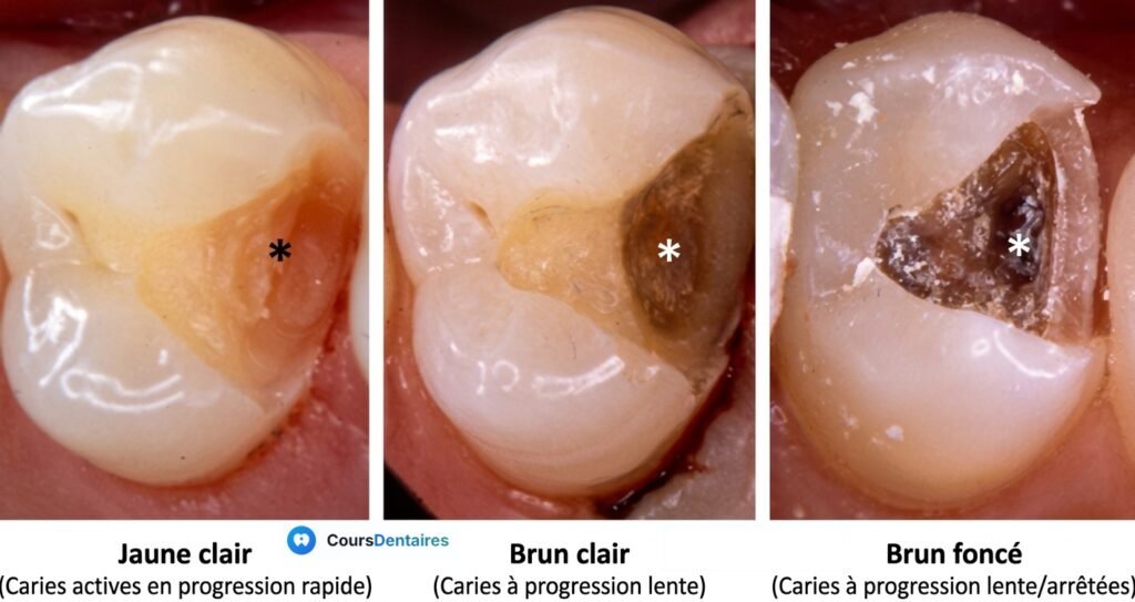 Photo clinique d'une carie active sur molaire temporaire (dentine jaune-brunâtre visible)