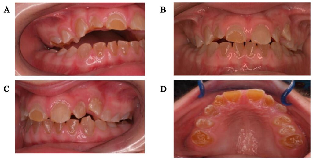  dentinogénèse imparfaite