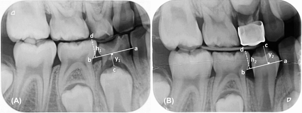 Radiographie montrant une lyse osseuse interradiculaire sur molaire temporaire