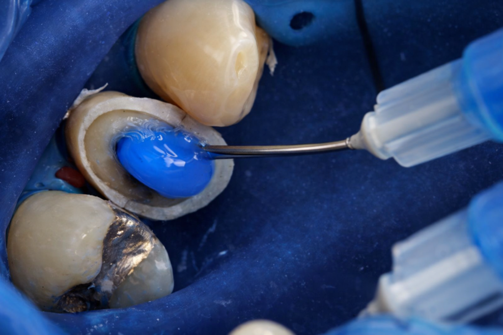 Reconstitution complexe des dents