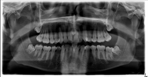 mesiodens supernumerary tooth panoramic X-ray