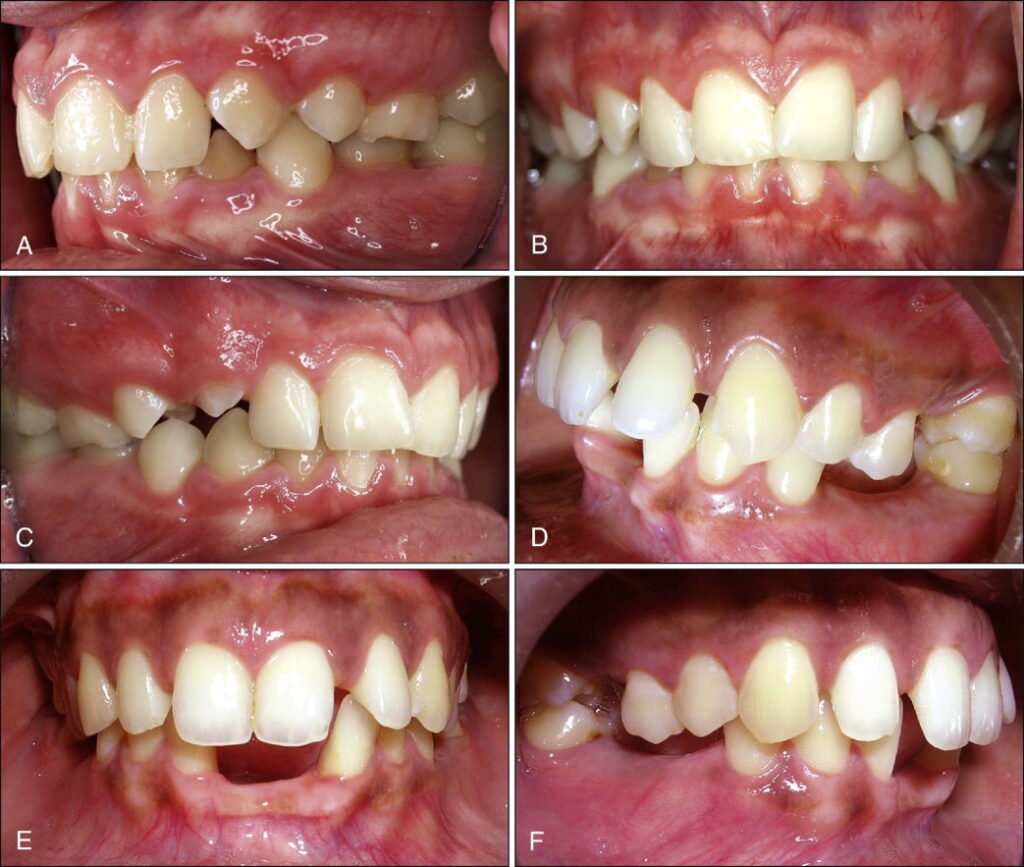 Photo clinique d'une supraclusion profonde (recouvrement incisif excessif)