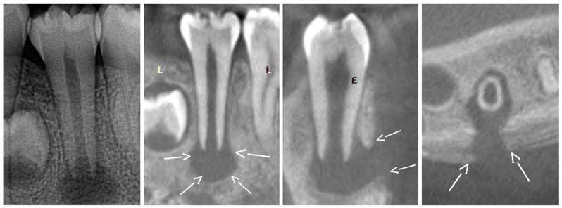 dent immature (apex ouvert, dentine fine)