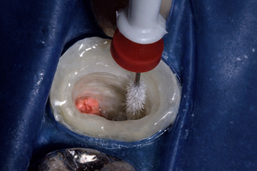 Reconstitution complexe des dents