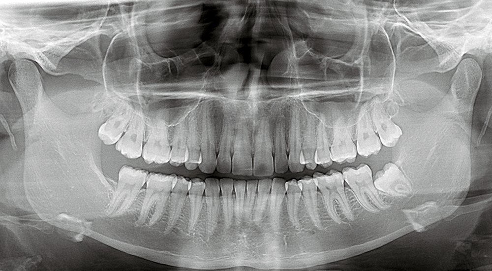 dental panoramic X-ray orthopantomogram