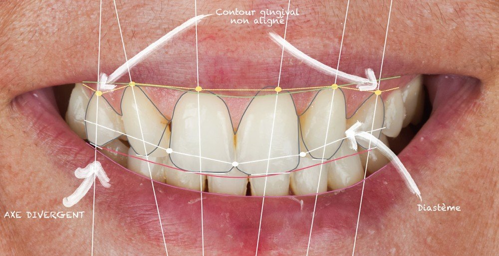 Analyse esthétique du sourire