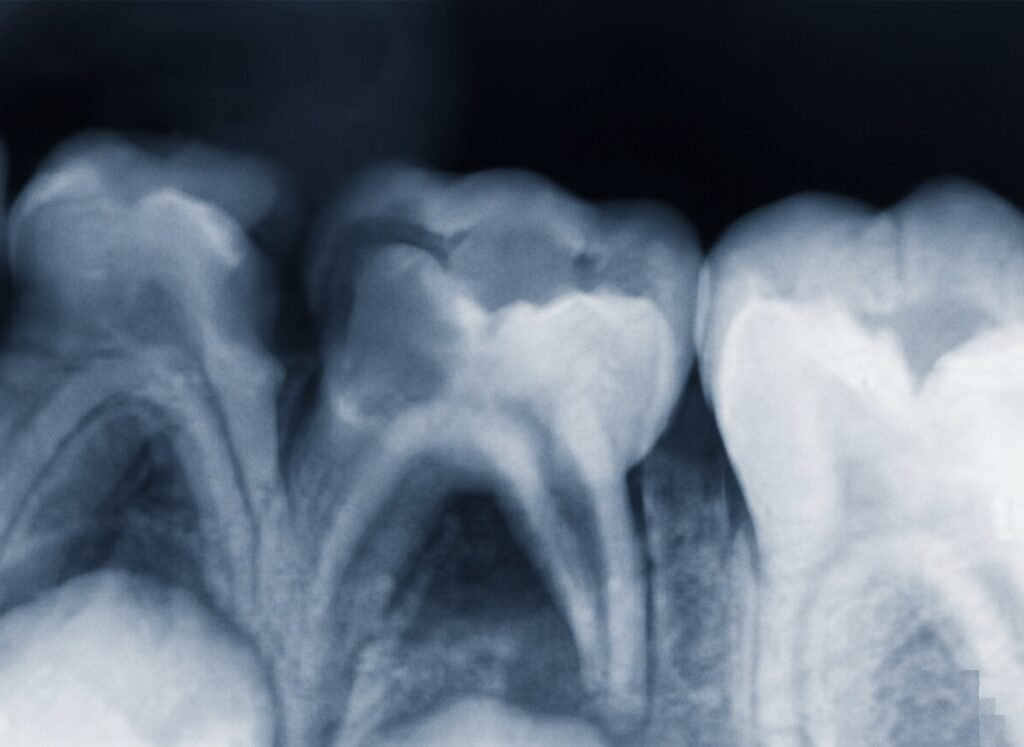 Atteinte de la furcation
