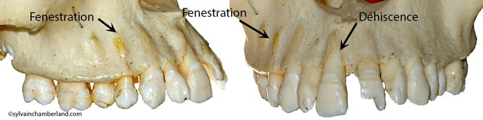 Fenestrations et Déhiscences