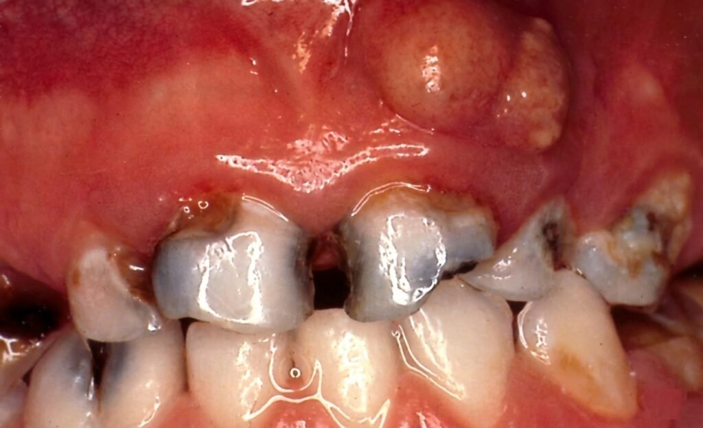 Pathologies périapicales : Parodontites apicales
