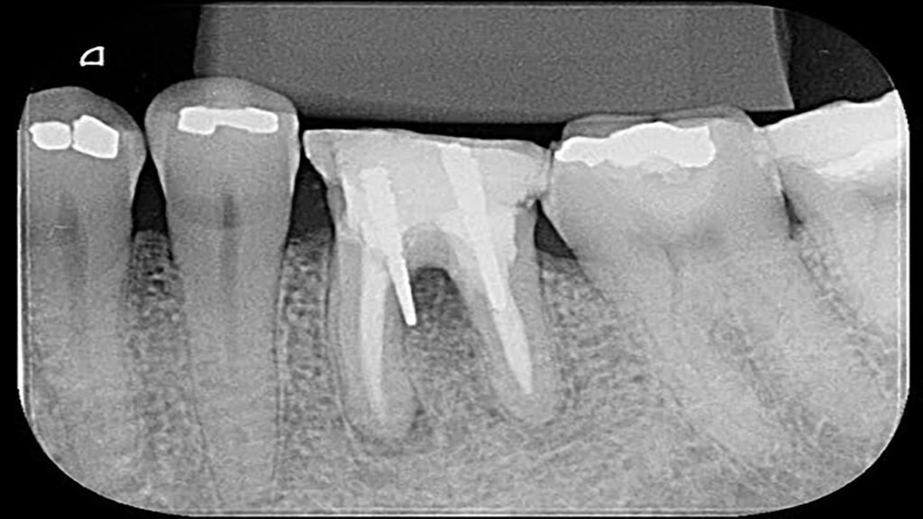 Radiographie montrant une perforation ou faux canal