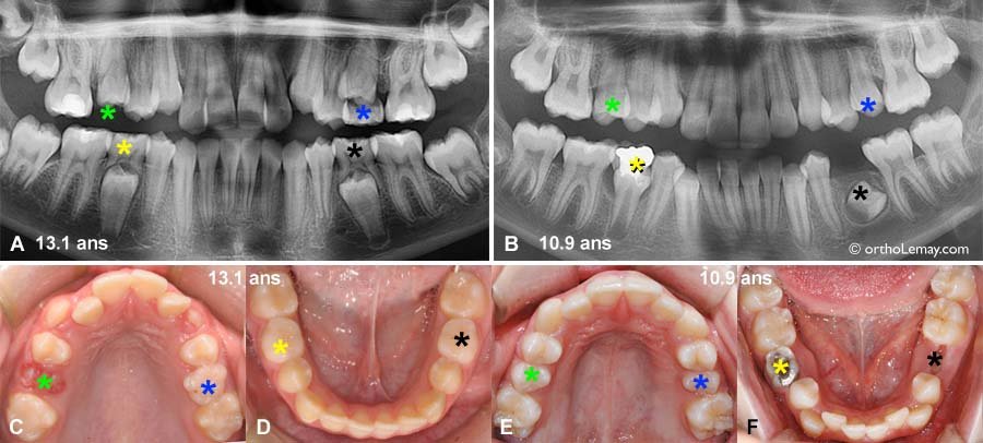 Résorption radiculaire temporaire