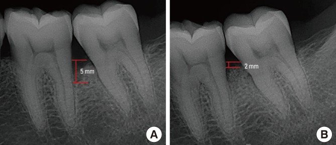 Radiographie d'une lésion à 3 parois avant/après traitement