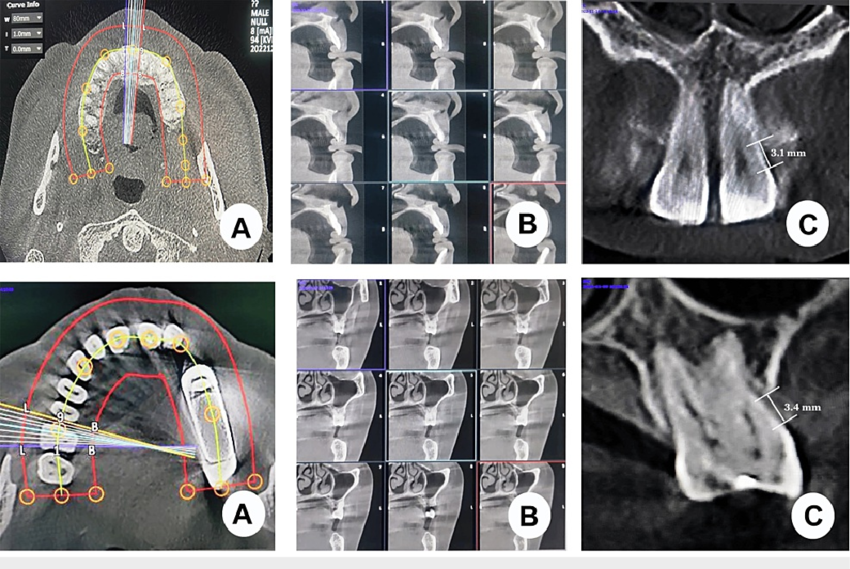 Coupe CBCT montrant un défaut osseux en 3D