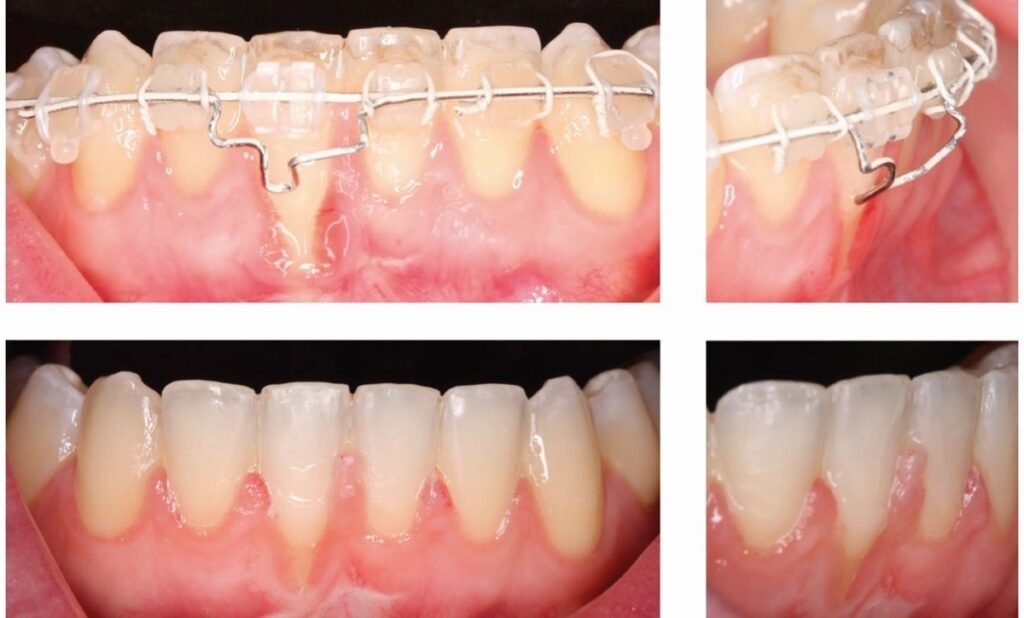 orthodontic braces gum recession incisors