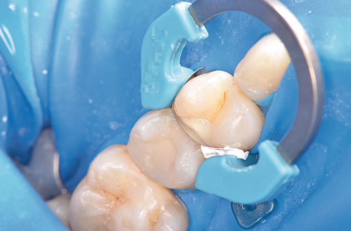 posterior composite class II centripetal layering sectional matrix