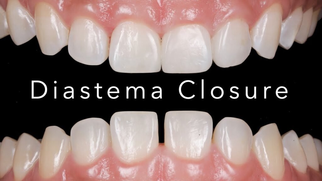 dental diastema before after composite closure