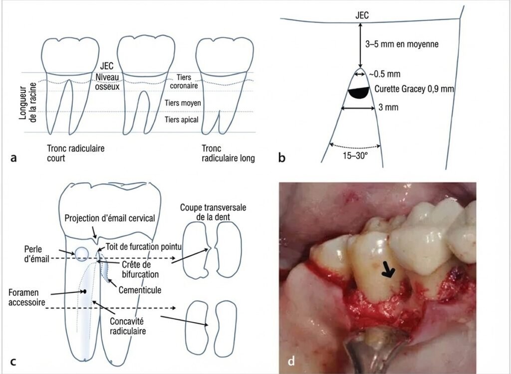 Illustration des concavités radiculaires et sillons furcatoires sur molaires mandibulaires