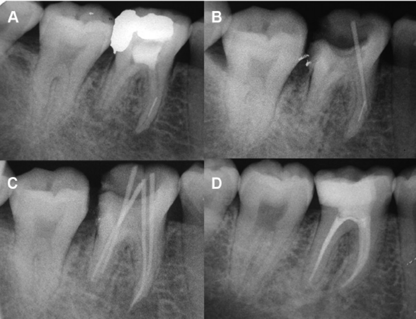 Radiographie avec instrument fracturé visible