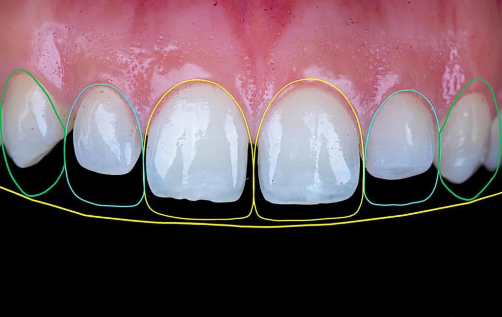 composite resin layering dental anterior tooth aesthetic