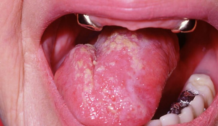 oral mucosa lesions elderly candidiasis