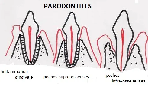 Image : Schéma anatomique comparant poche supra-osseuse vs intra-osseuse
Mot-clé de recherche : periodontal pocket infrabony defect anatomy diagram
Placement : Après la définition des LIO
