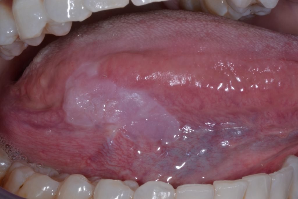 oral leukoplakia tongue lesion clinical