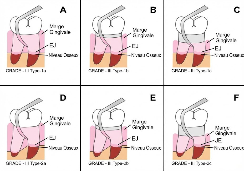 4. Classification de Glickman
