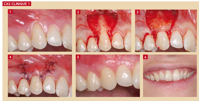 Greffes Conjonctives Enfouies 