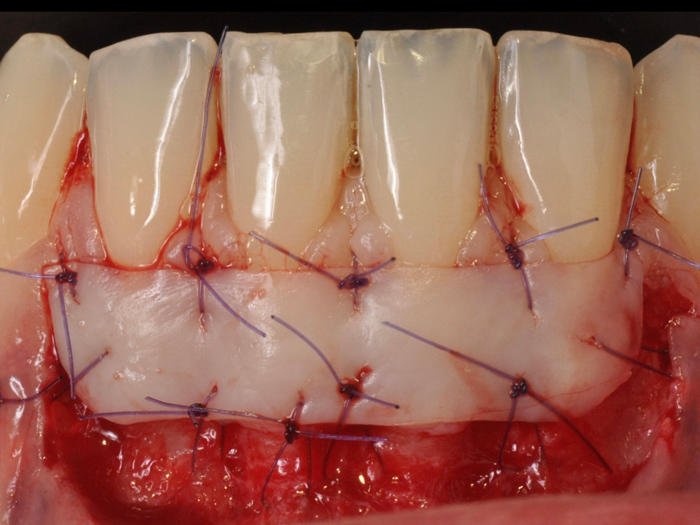 Greffes Épithélio-Conjonctives 