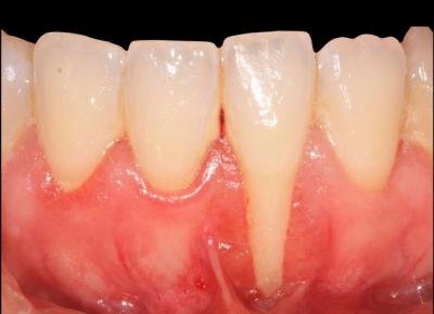 Récessions Gingivales