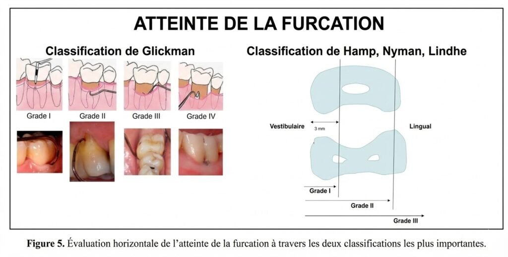 Classification de Hamp, Nyman et Lindhe (1977)