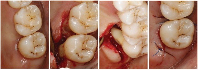 Photo clinique ou illustration du débridement instrumental en zone de furcation