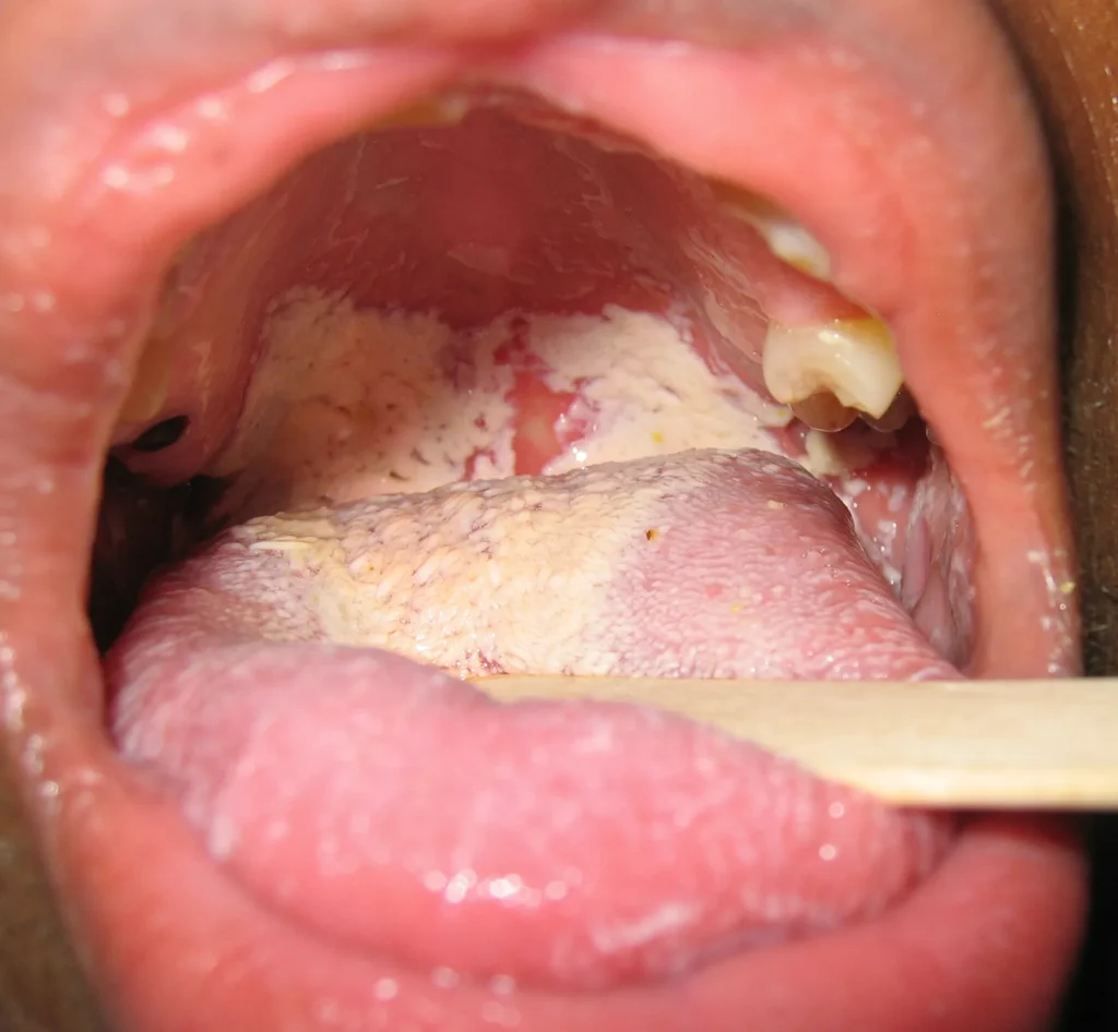oral candidiasis thrush white patches mouth