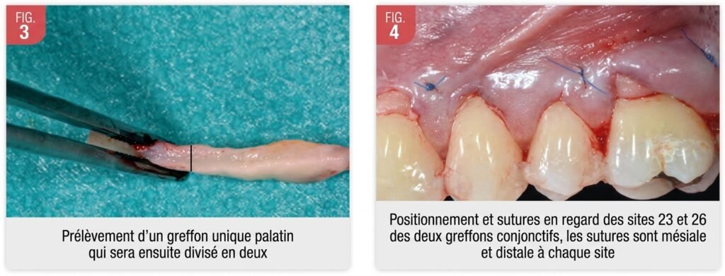 Schéma ou photo illustrant la technique de l'enveloppe sous-épithéliale avec greffon conjonctif glissé

