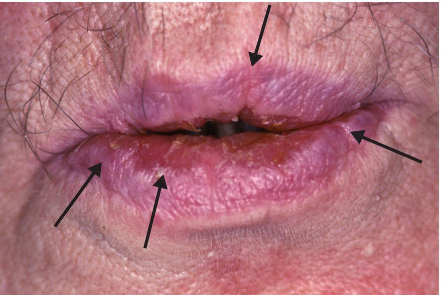 dry mouth xerostomia elderly medication