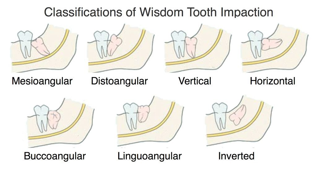 impacted tooth vs erupting tooth diagram