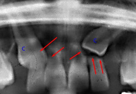  Résorption radiculaire sur incisive adjacente à une canine incluse