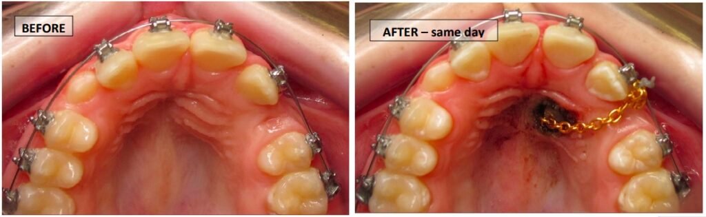 surgical exposure impacted canine bracket bonding
