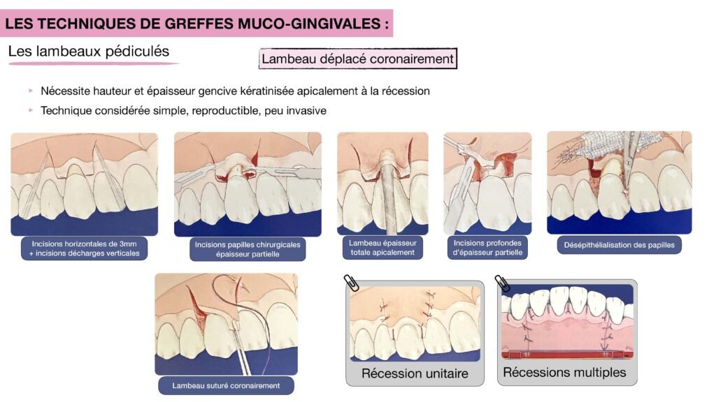 Schéma ou photo per-opératoire du lambeau déplacé latéralement (tracé d'incision + déplacement)

