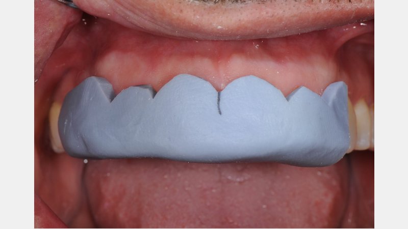 silicone key mock-up dental composite anterior restoration