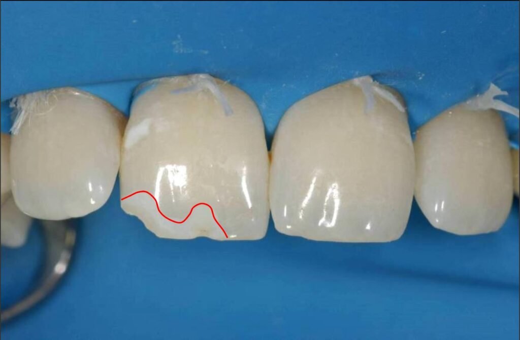 dental bevel enamel preparation composite bonding anterior