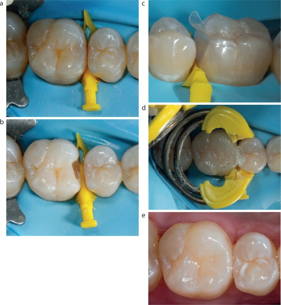 class II composite posterior tooth replacement restoration