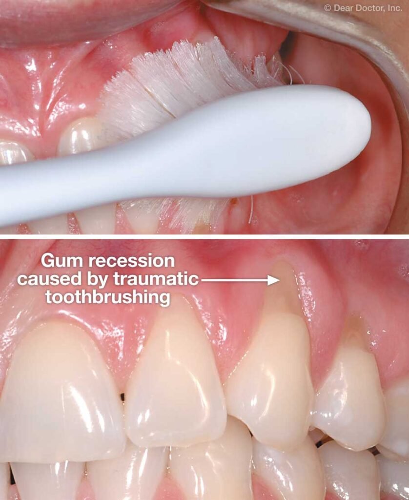 traumatic toothbrushing gum recession damage