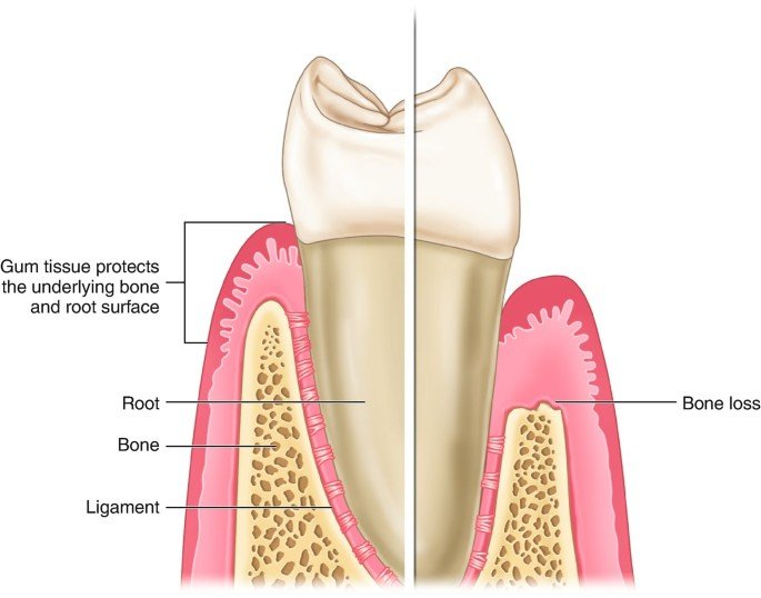gingival recession anatomy root exposure diagram