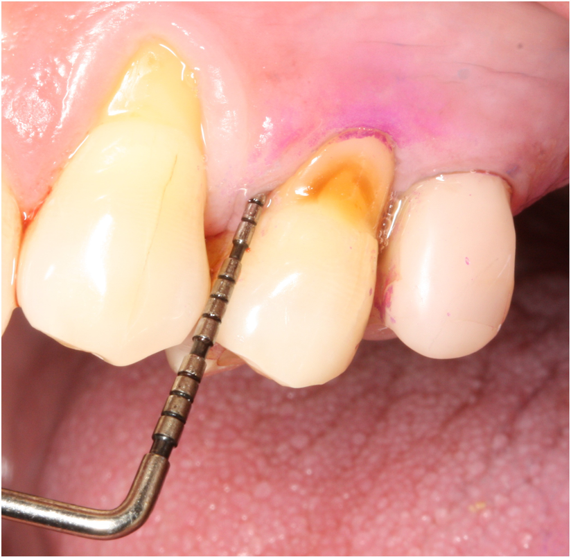 5. Prévalence et Données Épidémiologiques